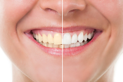 Zoom whitening middleboro